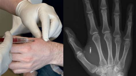 rfid chips to be placed in right arm|are rfid implants safe.